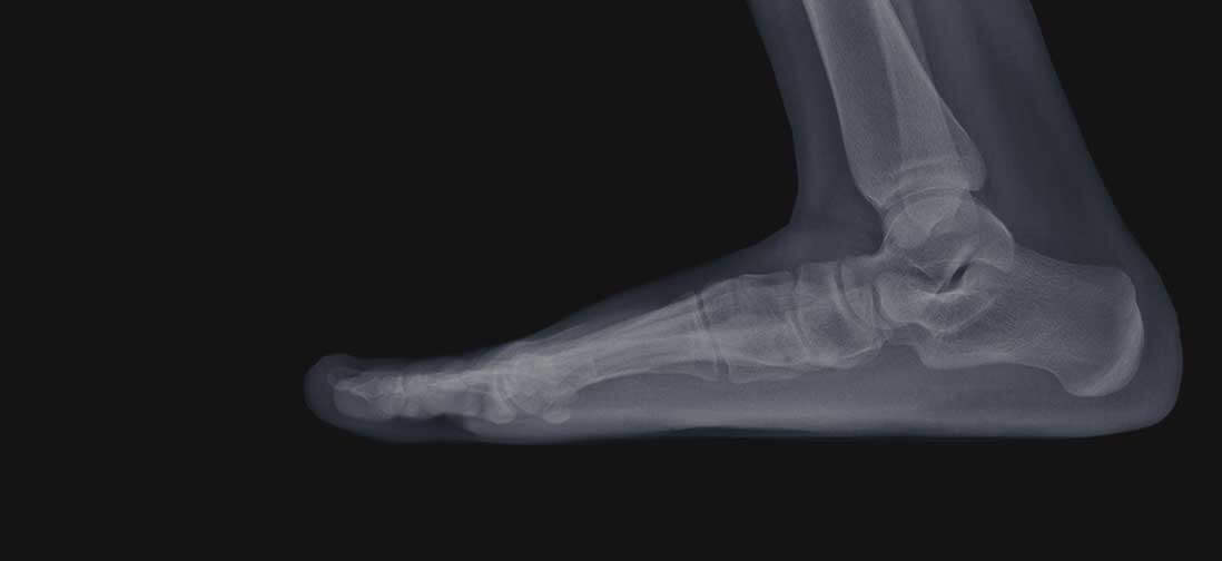X-ray of an foot